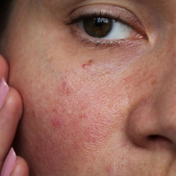 The Difference Between Sensitive and Sensitised Skin